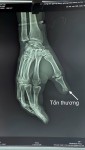 TRUNG TÂM Y TẾ KHU VỰC ĐOAN HÙNG CẢNH BÁO TAI NẠN LAO ĐỘNG DO MÁY CƯA